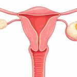 Ilustracja anatomiczna – guzy graniczne jajnika (BOTs) – leczenie ginekologiczne Gdynia