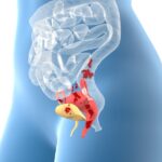 Endometriosis, female disease, 3D educational, medical illustrat