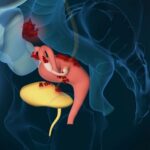 Endometrioza częstsza po lewej stronie – co to oznacza i jak wygląda leczenie