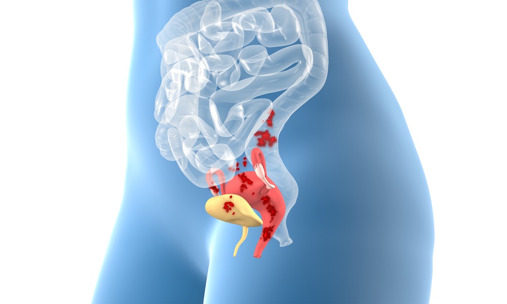 Endometriosis, female disease, 3D educational, medical illustrat