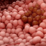 Leczenie pierwotnego raka jajnika – specjalista ginekologii onkologicznej Gdynia Trójmiasto