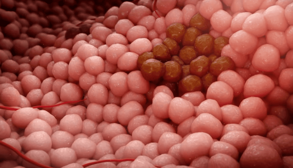 Leczenie pierwotnego raka jajnika – specjalista ginekologii onkologicznej Gdynia Trójmiasto