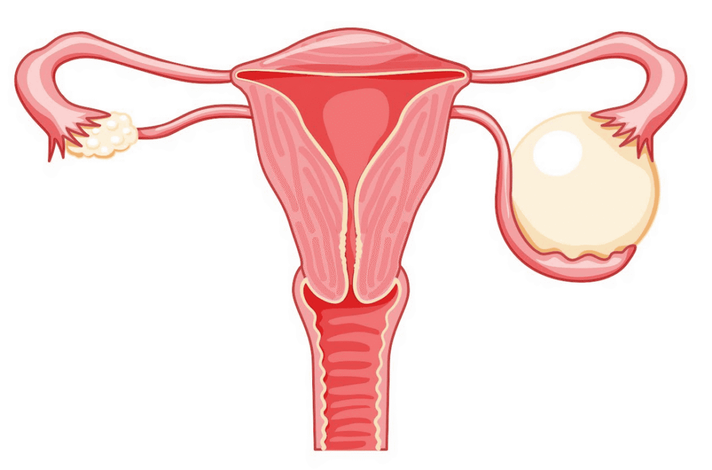 Torbiel lub guz jajnika – diagnostyka i leczenie – ginekolog Gdynia