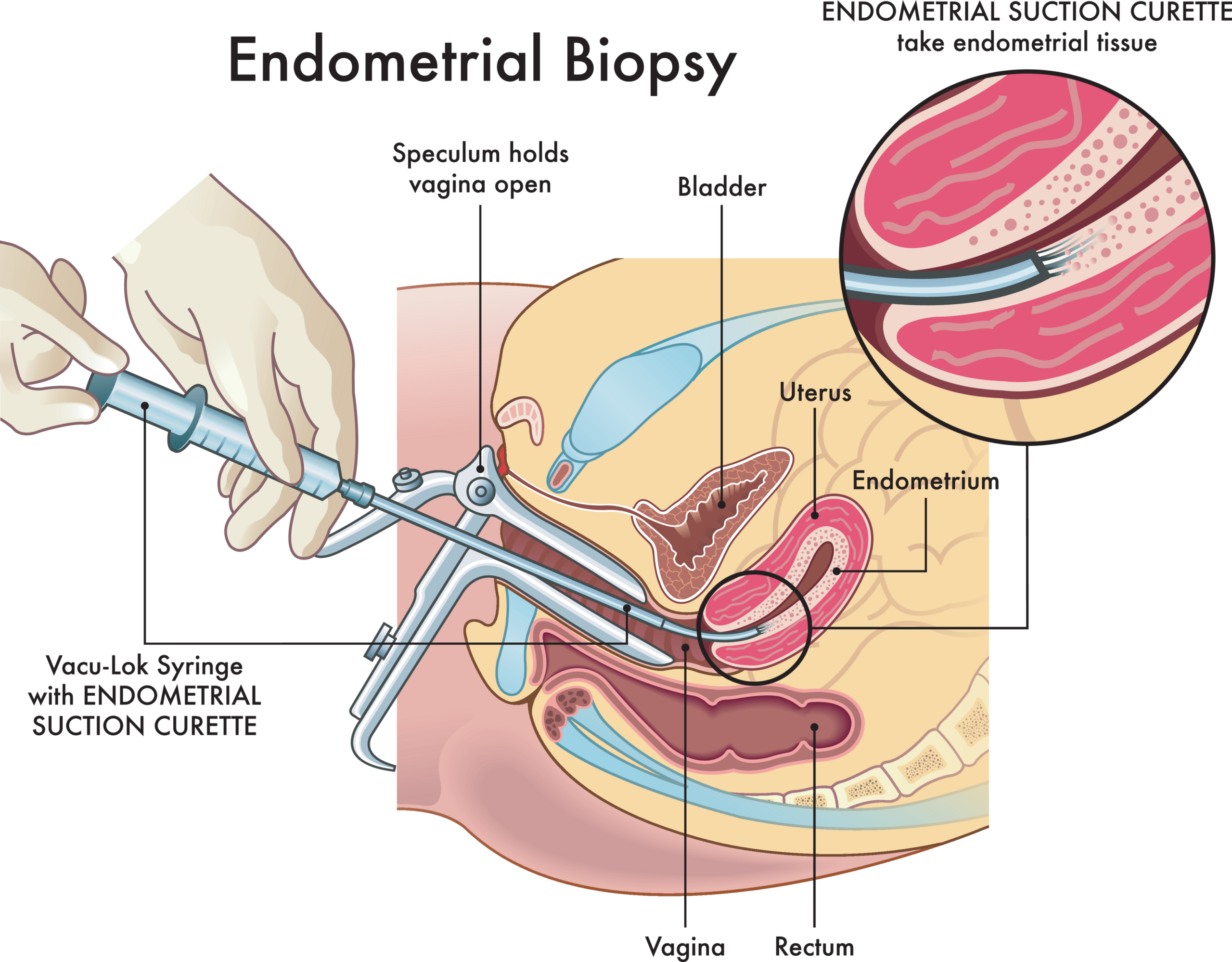Biopsja endometrium