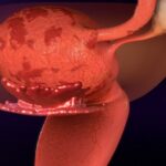 Endometrioza objawy