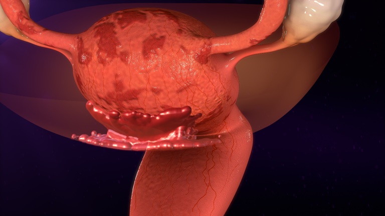 Endometrioza objawy