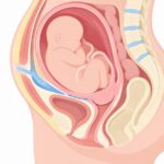 FAUCS – zewnątrzotrzewnowe cięcie cesarskie, schemat anatomiczny
